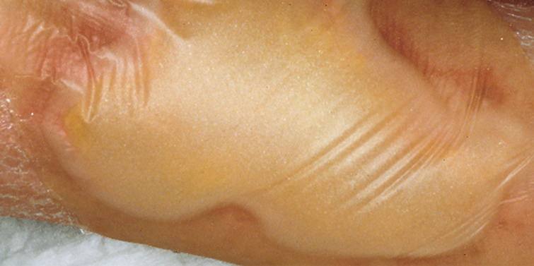 Hydrocoll® steril in 10x10 cm, 1 Packung à 10 Stück